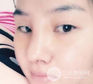 蒜頭鼻整形價(jià)格和對(duì)比照片案例