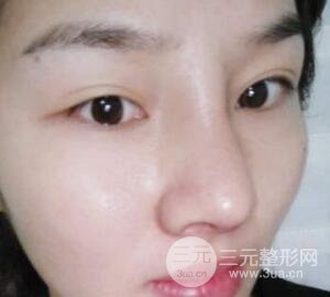 蒜頭鼻整形價(jià)格和對(duì)比照片案例