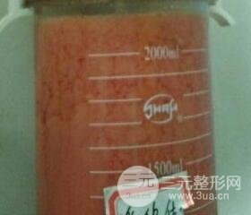 大腿環(huán)吸抽脂價格和圖片案例