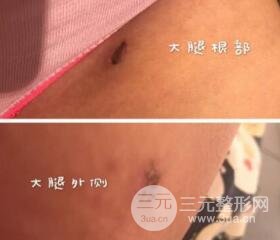 大腿環(huán)吸抽脂價格和圖片案例