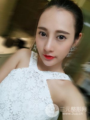 隆鼻失敗修復(fù)手術(shù)真實案例以及前后對比圖——青海康華馮相周醫(yī)生做的