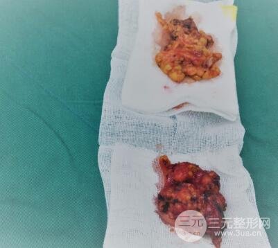 深圳蘭喬醫(yī)院假體隆胸和副乳切除圖片案例