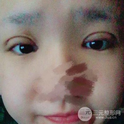 汕頭愛麗諾蘇國藝給我做的雙眼皮手術，把前后的對比圖片分享給大家