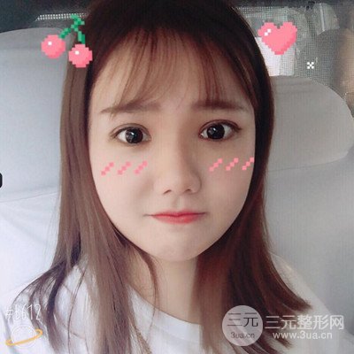 汕頭愛麗諾蘇國藝給我做的雙眼皮手術，把前后的對比圖片分享給大家
