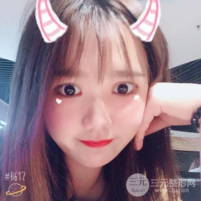汕頭愛麗諾蘇國藝給我做的雙眼皮手術，把前后的對比圖片分享給大家