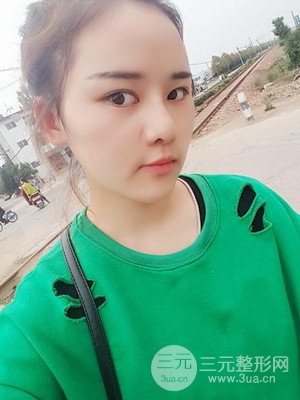 硅膠假體墊下巴真實案例，汕頭愛麗諾蘇國藝做的