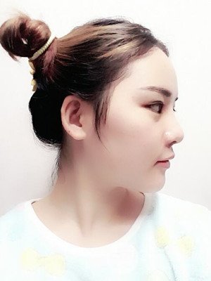 硅膠假體墊下巴真實案例，汕頭愛麗諾蘇國藝做的