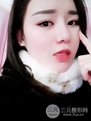 硅膠假體墊下巴真實案例，汕頭愛麗諾蘇國藝做的