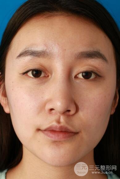 深圳源美做隆鼻失敗修復(fù)價格案例