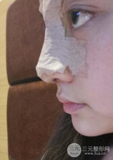 深圳源美做隆鼻失敗修復(fù)價格案例