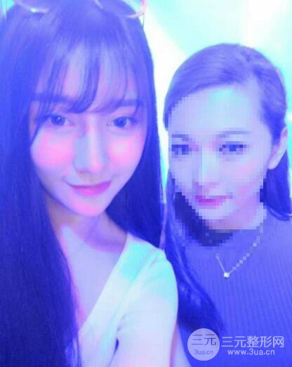 深圳源美做隆鼻失敗修復(fù)價格案例