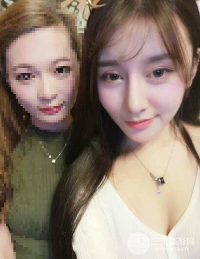 深圳源美做隆鼻失敗修復(fù)價格案例