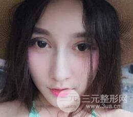 深圳源美做隆鼻失敗修復價格案例