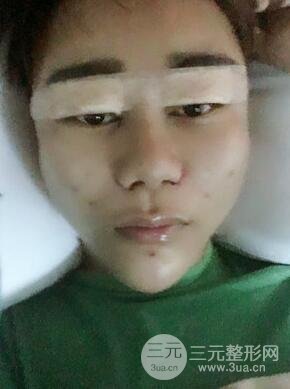 切開(kāi)雙眼皮+自體脂肪填充全臉真實(shí)案例分享，并附上前后對(duì)比圖片~