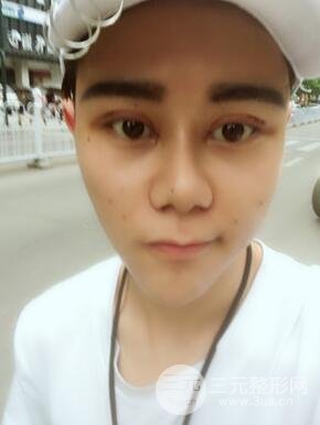 切開(kāi)雙眼皮+自體脂肪填充全臉真實(shí)案例分享，并附上前后對(duì)比圖片~