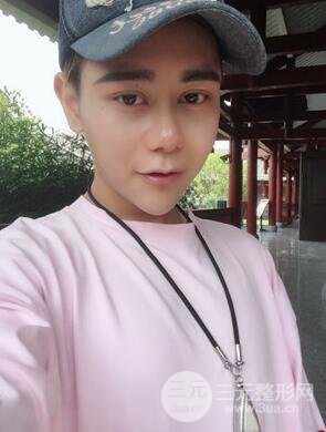 切開(kāi)雙眼皮+自體脂肪填充全臉真實(shí)案例分享，并附上前后對(duì)比圖片~