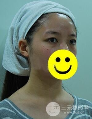 內(nèi)切祛眼袋手術(shù)真實(shí)案例，并附上前后對(duì)比圖片