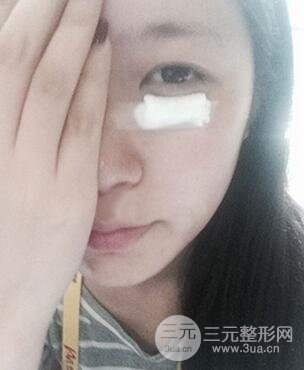 內(nèi)切祛眼袋手術(shù)真實(shí)案例，并附上前后對(duì)比圖片