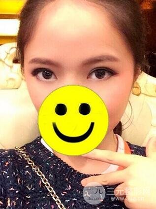 內(nèi)切祛眼袋手術(shù)真實(shí)案例，并附上前后對(duì)比圖片