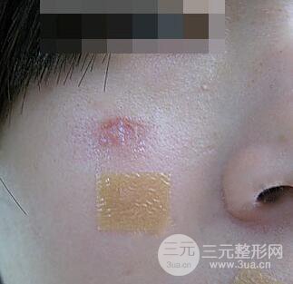 激光祛疤非手術(shù)真實果圖案例