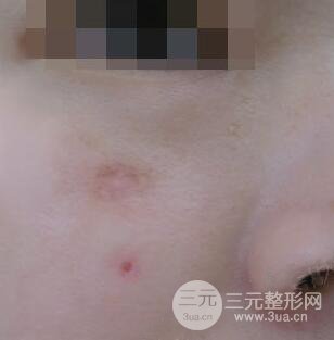 激光祛疤非手術(shù)真實果圖案例