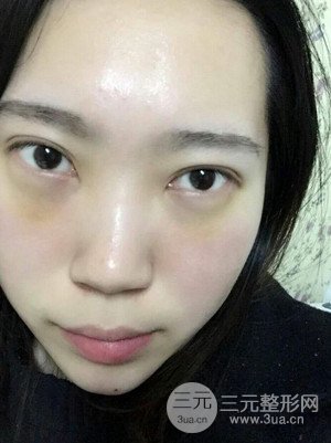 內(nèi)切祛眼袋手術(shù)真實(shí)案例，武漢天申胡麗醫(yī)生做的