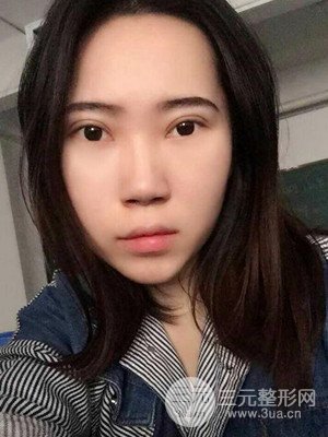 內(nèi)切祛眼袋手術(shù)真實(shí)案例，武漢天申胡麗醫(yī)生做的