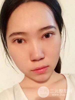 內(nèi)切祛眼袋手術(shù)真實(shí)案例，武漢天申胡麗醫(yī)生做的