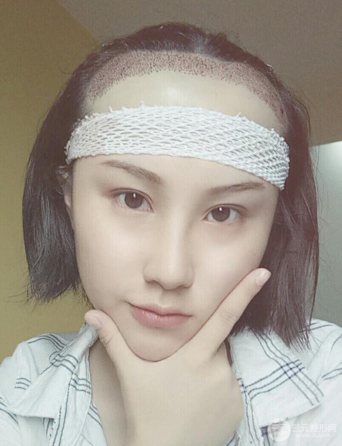 武漢天申胡麗醫(yī)生發(fā)際線種植真實(shí)案例，并附上前后對比圖片