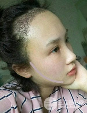 武漢天申胡麗醫(yī)生發(fā)際線種植真實(shí)案例，并附上前后對比圖片