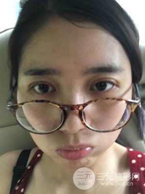 雙眼皮真實(shí)案例分享——武漢繹君毛林醫(yī)生做的