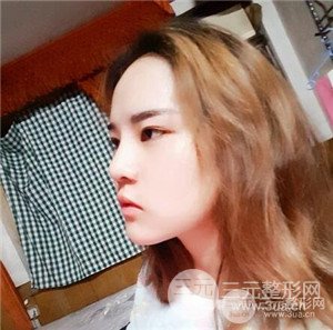 膨體墊下巴術(shù)后一個月恢復對比