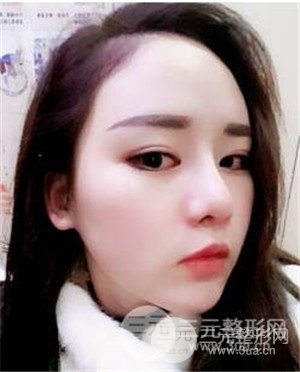 膨體墊下巴術(shù)后一個月恢復對比