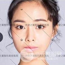 面部自體脂肪填充+隆鼻整形+雙眼皮案例，恢復果照片~