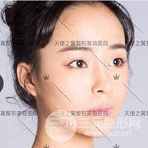 面部自體脂肪填充+隆鼻整形+雙眼皮案例，恢復果照片~