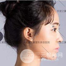 面部自體脂肪填充+隆鼻整形+雙眼皮案例，恢復果照片~