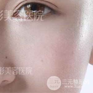 芭比雙眼皮+去眼袋案例分享，還有恢復過程照片哦~