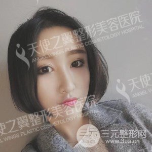 芭比雙眼皮+去眼袋案例分享，還有恢復過程照片哦~