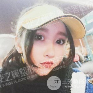 芭比雙眼皮+去眼袋案例分享，還有恢復過程照片哦~