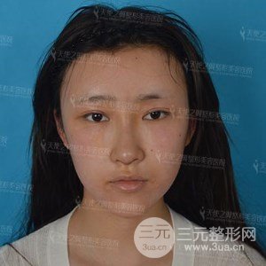 自體脂肪面部填充+全鼻金雕真實案例，恢復照片分享~