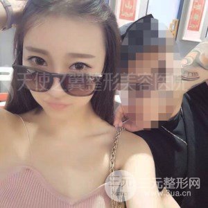 自體脂肪面部填充+全鼻金雕真實案例，恢復照片分享~