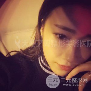 自體脂肪面部填充+全鼻金雕真實案例，恢復照片分享~