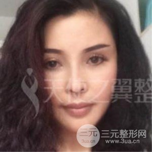 隆鼻整形修復+自體脂肪詳細部填充案例分享~