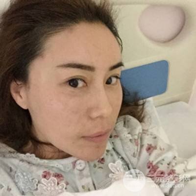 武漢美侖陳遠(yuǎn)海自體脂肪填充全臉案例，附上前后對(duì)比圖片