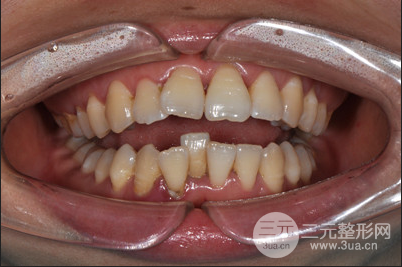 昆明醫(yī)科大學附屬口腔醫(yī)院黎明牙齒矯正果分享