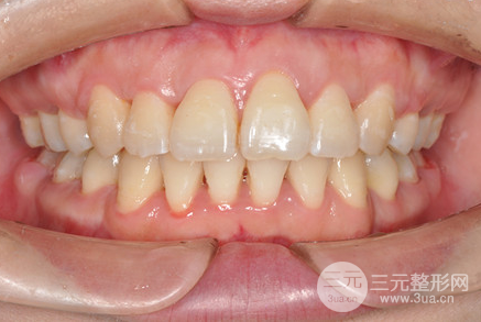 昆明醫(yī)科大學附屬口腔醫(yī)院黎明牙齒矯正果分享