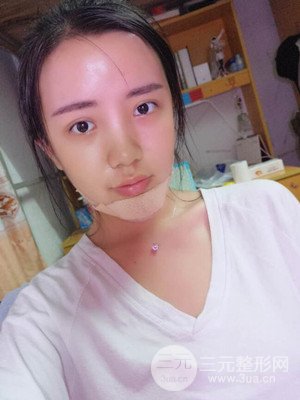 自體脂肪填充額頭+豐下巴真實案例，昆明都市儷人金海坤醫(yī)生做的