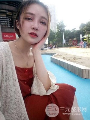 切開雙眼皮+假體隆鼻案例，前后對比圖分享