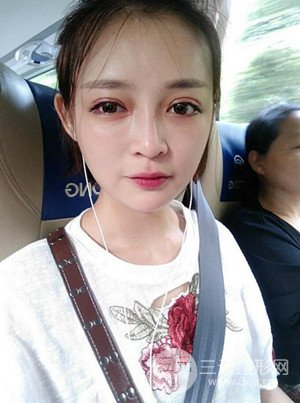 切開雙眼皮+假體隆鼻案例，前后對比圖分享