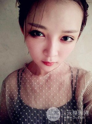 切開雙眼皮+假體隆鼻案例，前后對比圖分享